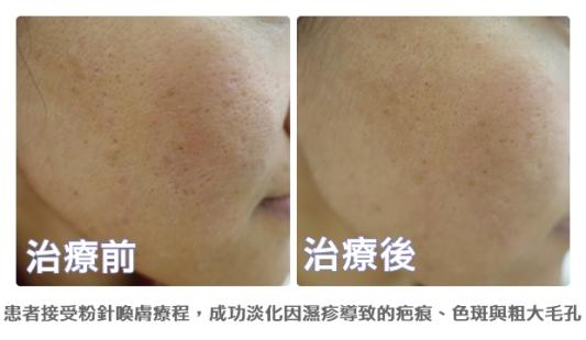 濕疹後粉針喚膚 輕熟女揮別疤痕色斑與粗大毛孔
