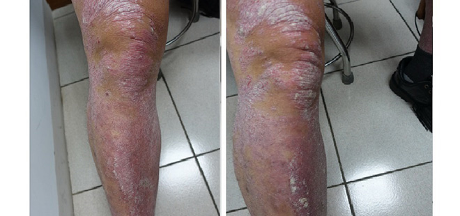 罹患乾癬不敢穿短褲 中醫調理大幅縮短復原期