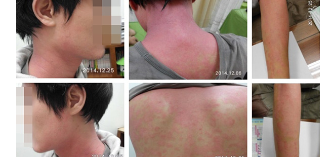 急性濕疹合併乾癬 中醫成功根治長年宿疾