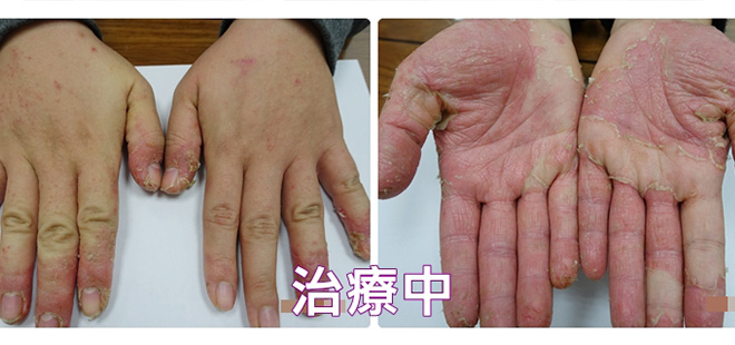 熬過反彈期 餐廳服務生3個月成功治癒雙手汗皰疹