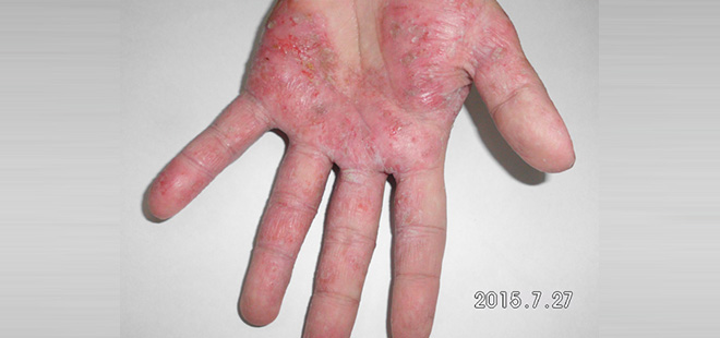 〈汗皰疹治療〉女騎士汗皰疹雙手難煞車 中醫調理須撐過反彈期
