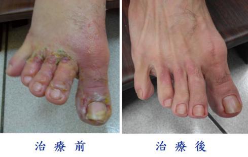 急性汗皰疹 中醫治療一周見效