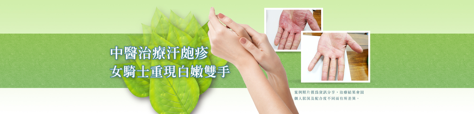 女騎士汗皰疹雙手難煞車 中醫調理須撐過反彈期 女騎士汗皰疹雙手難煞車 中醫調理須撐過反彈期