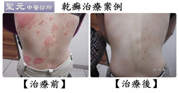 熬過體內排毒反彈期 治癒乾癬指日可待