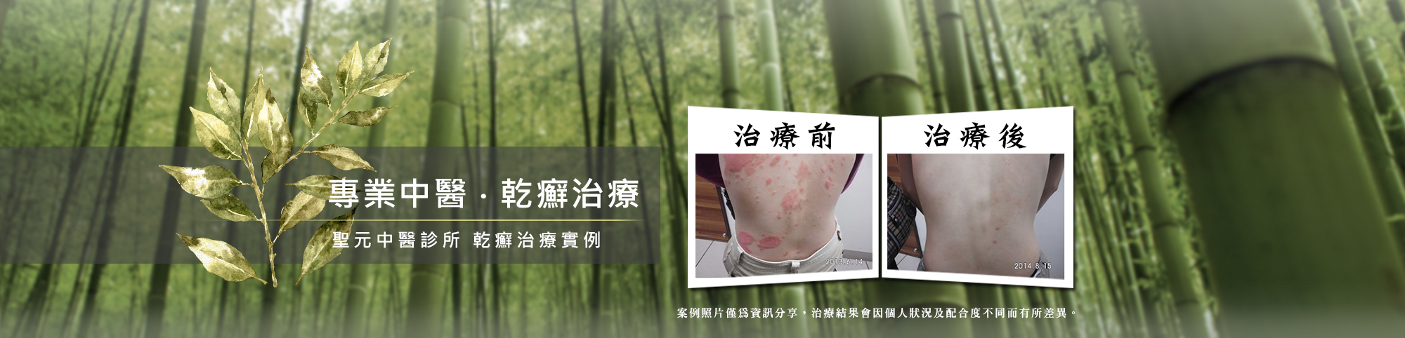 熬過體內排毒反彈期 治癒乾癬指日可待 熬過體內排毒反彈期 治癒乾癬指日可待