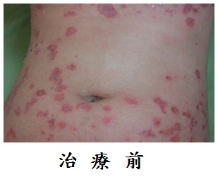 濕疹治療要及早 中醫療法須耐心但安心