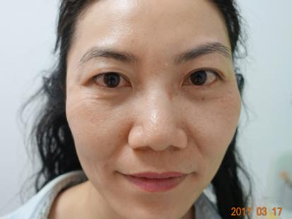 中醫針灸也能美容 拉提除皺有效果