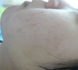 別再妝了! 中醫微針還你健康膚質