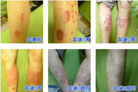 乾癬的治療