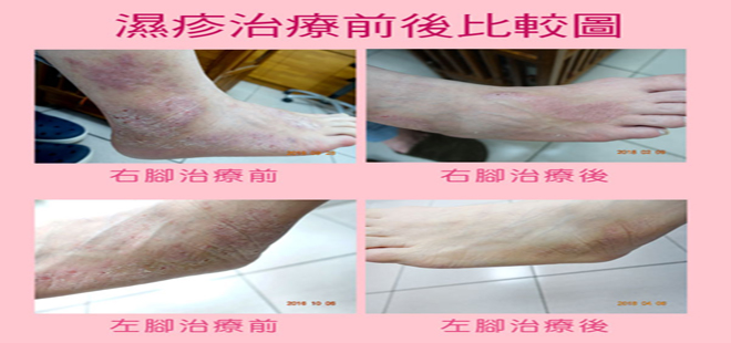 雙腳溼疹
