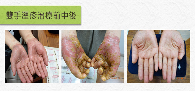 雙手溼疹