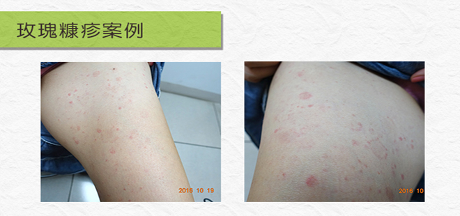 玫瑰糠疹