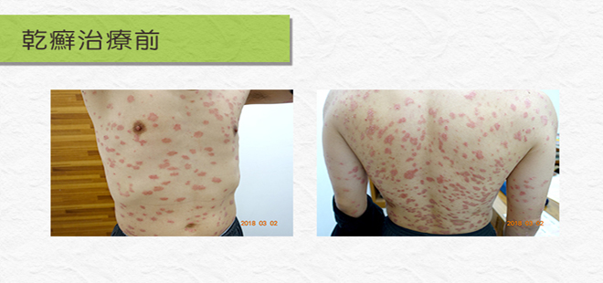 乾癬