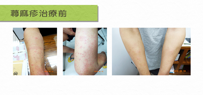 蕁麻疹