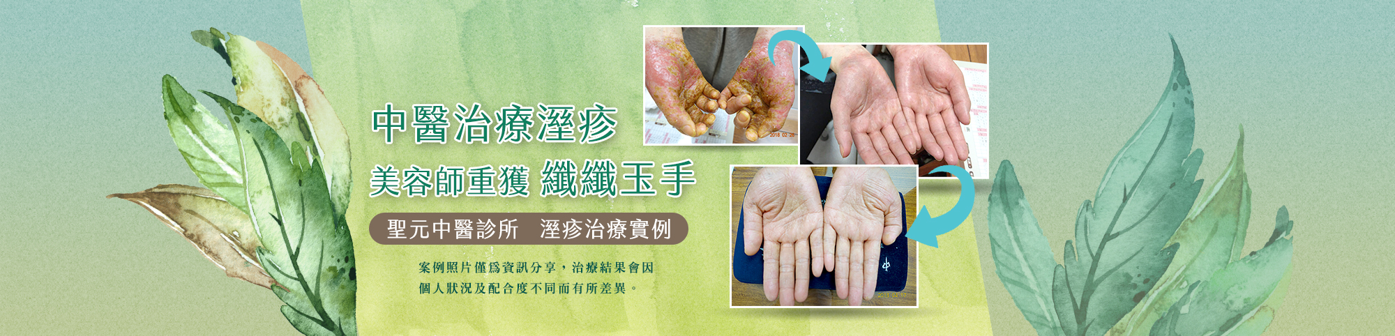 溼疹案例 溼疹案例