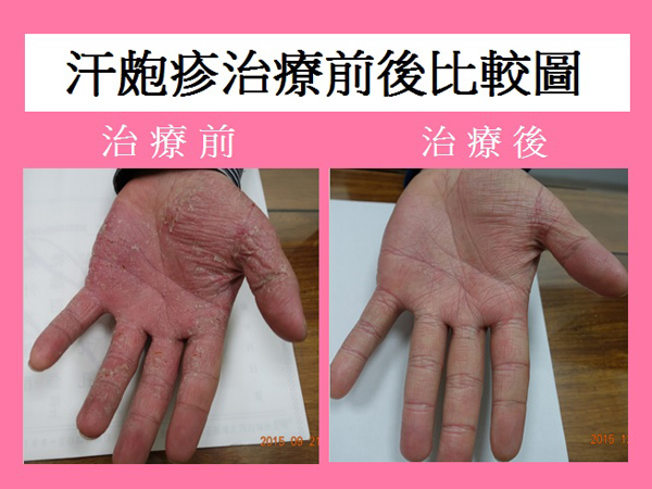 〈汗皰疹治療〉女騎士汗皰疹雙手難煞車 中醫調理須撐過反彈期