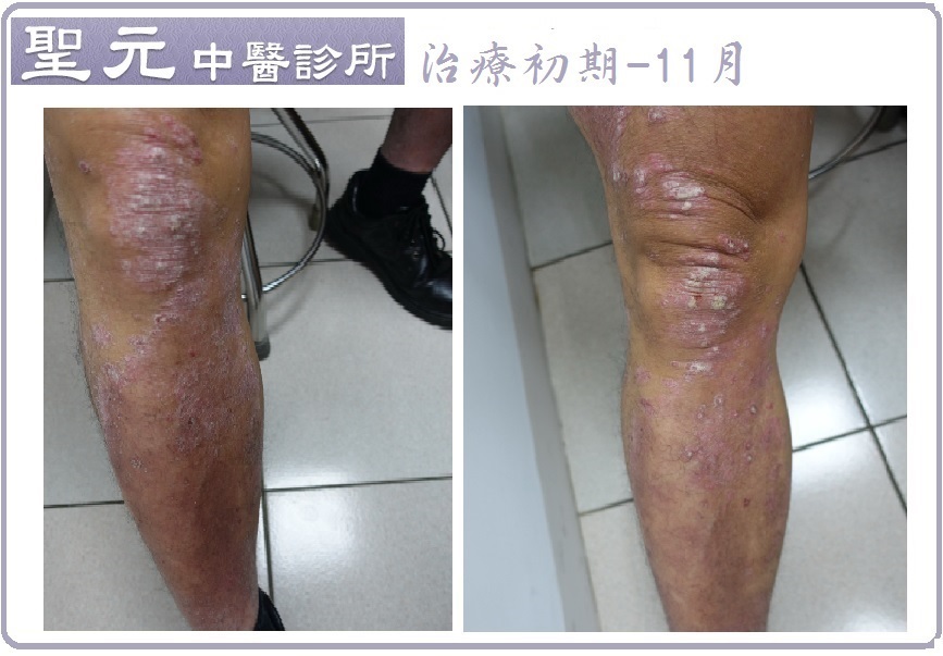 罹患乾癬不敢穿短褲 中醫調理大幅縮短復原期1