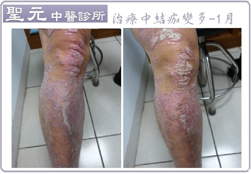 罹患乾癬不敢穿短褲 中醫調理大幅縮短復原期