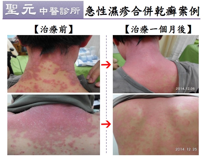 急性濕疹合併乾癬 中醫成功根治長年宿疾1