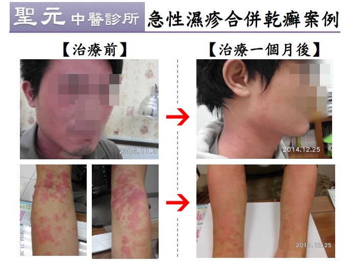 急性濕疹合併乾癬 中醫成功根治長年宿疾2