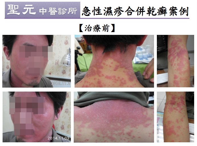 急性濕疹合併乾癬 中醫成功根治長年宿疾3