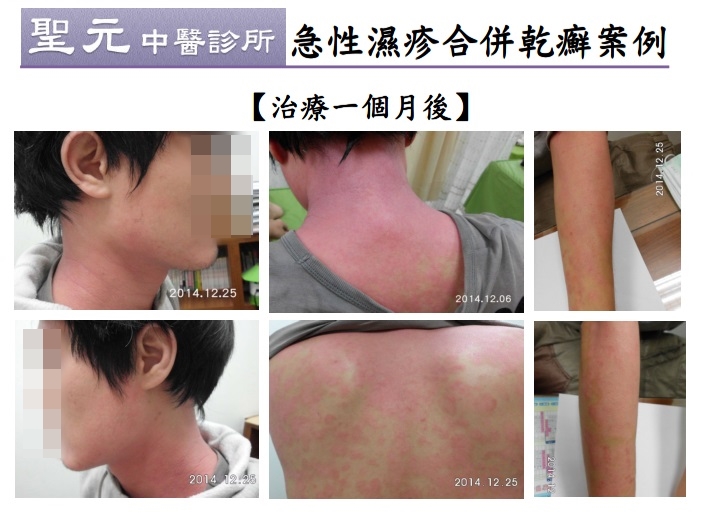 急性濕疹合併乾癬 中醫成功根治長年宿疾4