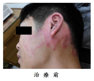 乾癬患者的飲食注意事項1