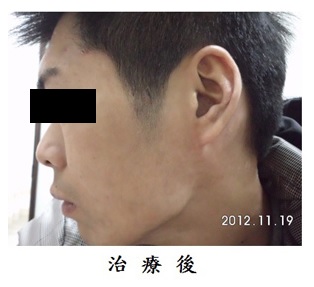 乾癬患者的飲食注意事項2