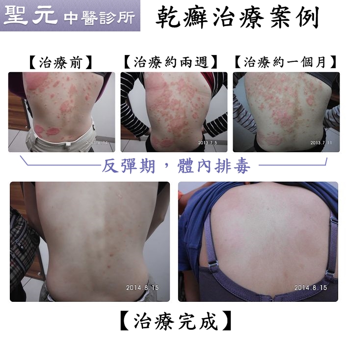 熬過體內排毒反彈期 治癒乾癬指日可待2
