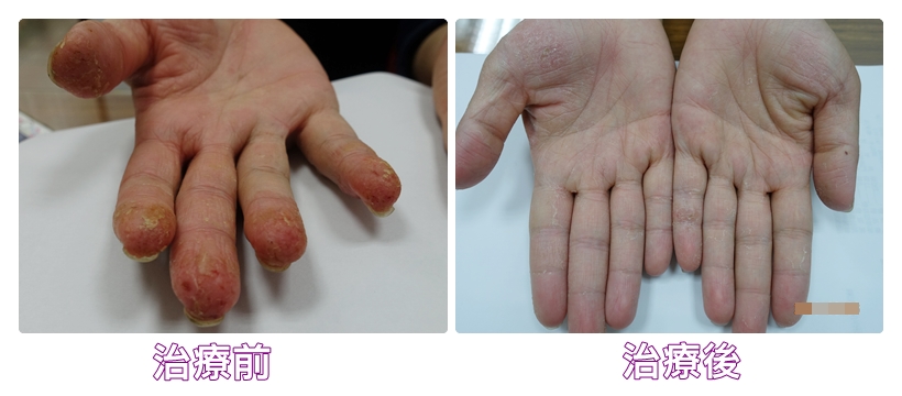 餐廳服務生3個月成功治癒雙手汗皰疹1
