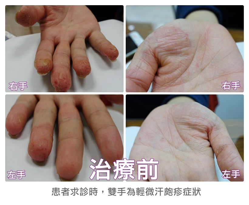 餐廳服務生3個月成功治癒雙手汗皰疹2