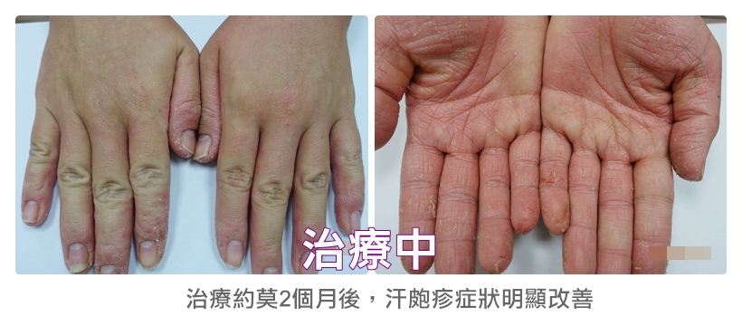 餐廳服務生3個月成功治癒雙手汗皰疹5