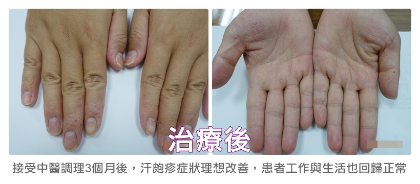 餐廳服務生3個月成功治癒雙手汗皰疹6