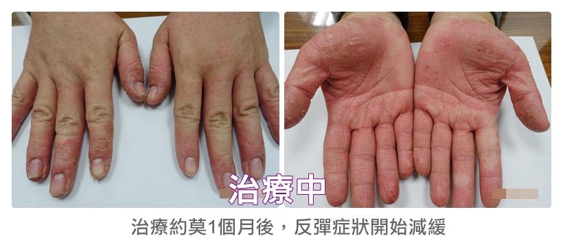 餐廳服務生3個月成功治癒雙手汗皰疹4-2