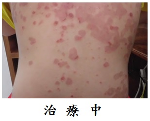 濕疹治療要及早2