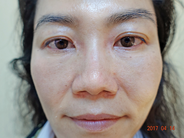 中醫針灸也能美容2