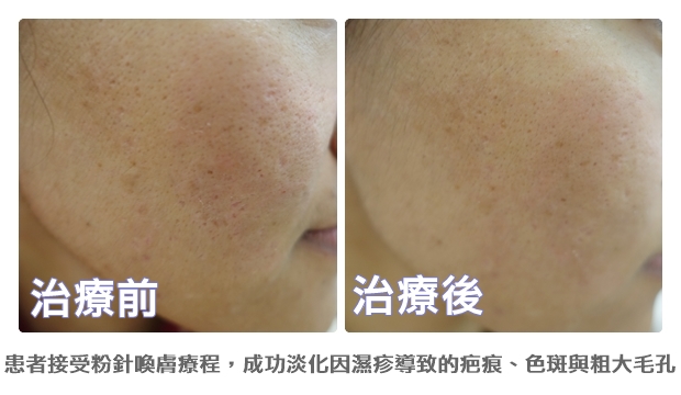 濕疹後粉針喚膚 1