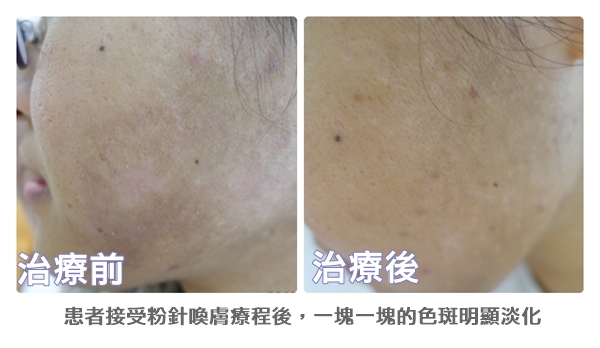 濕疹後粉針喚膚 2