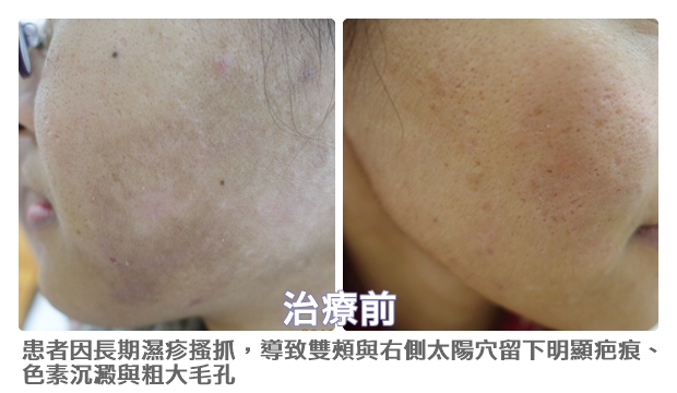 濕疹後粉針喚膚 3