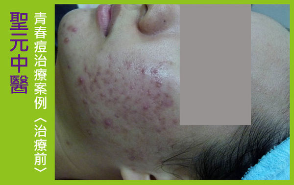 紅豆妹擺脫滿臉痘1