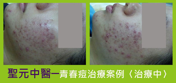 紅豆妹擺脫滿臉痘2