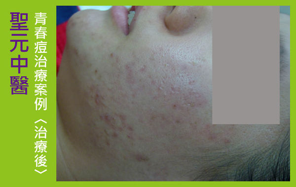 紅豆妹擺脫滿臉痘3